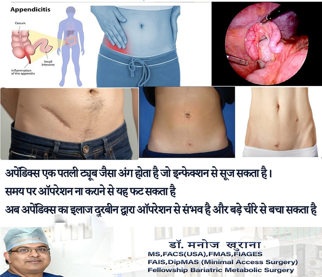 appendicitis treatment