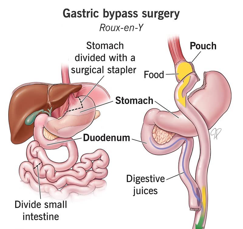 gastric bypass surgery